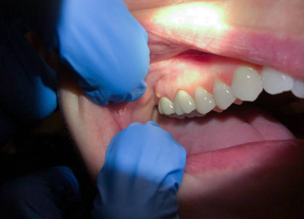 Best Emergency Dental Extractions in Williston, ND