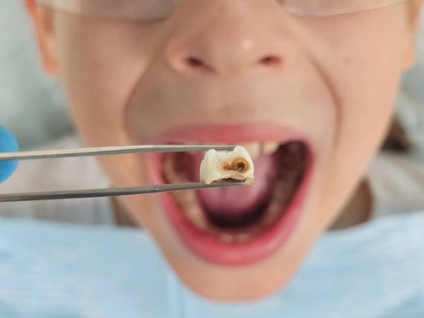Best Emergency Dentist for Lost Fillings or Crowns in Williston, ND